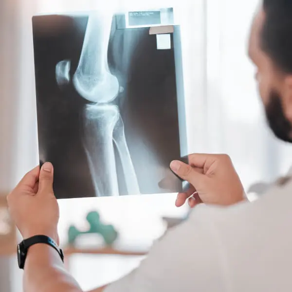 Un docteur regarde la radio d'un genou touché par l'arthrose.