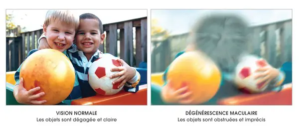 A quoi ressemble une vision touchée par une DMLA.