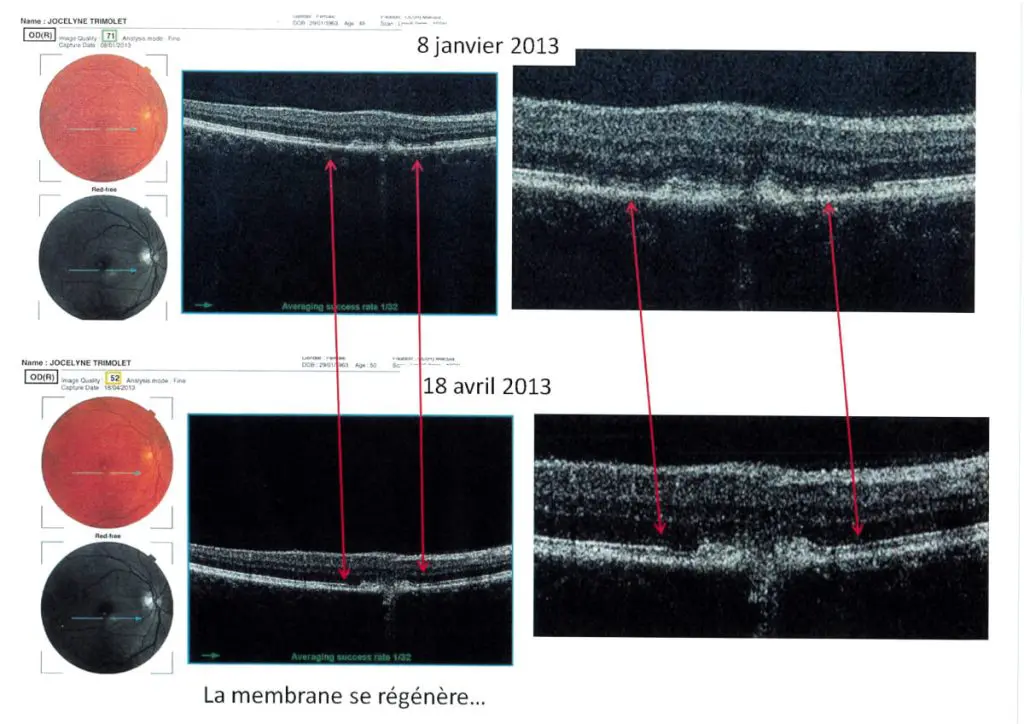 Scan de guérison de DMLA humide hémorragique fulgurante (dégénérescence maculaire liée à l'âge)