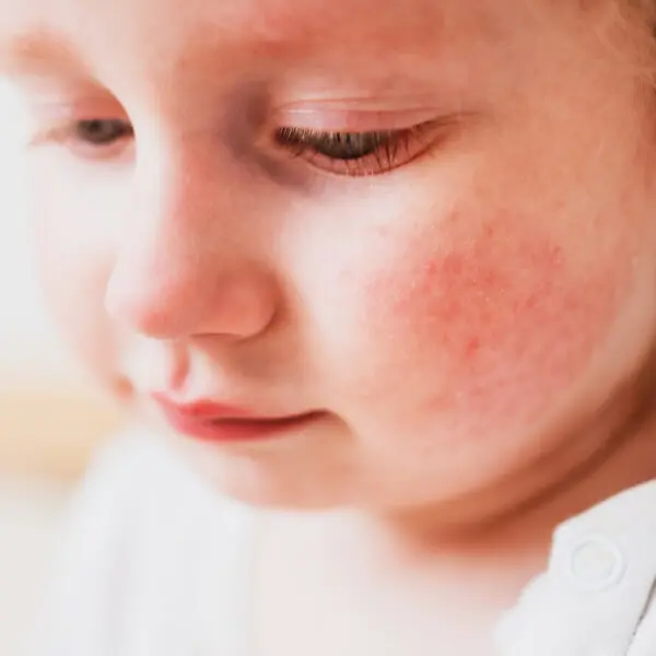 Un bébé avec de l'eczema sur la joue.