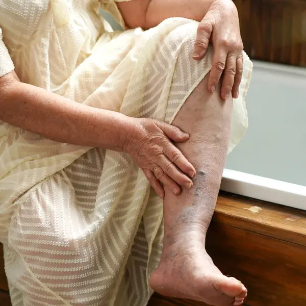 Une dame âgée se tient une jambe lourde avec mauvaise circulation.